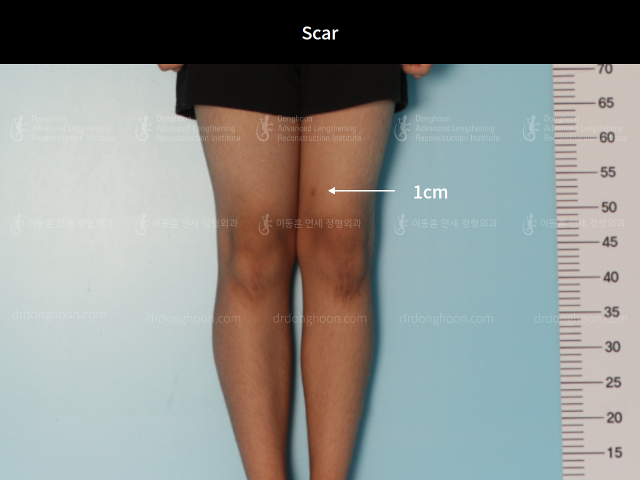 Before and after paediatric & adolescent knock knees, case 8413324, image 4, Dr. Donghoon institute (DALRI)