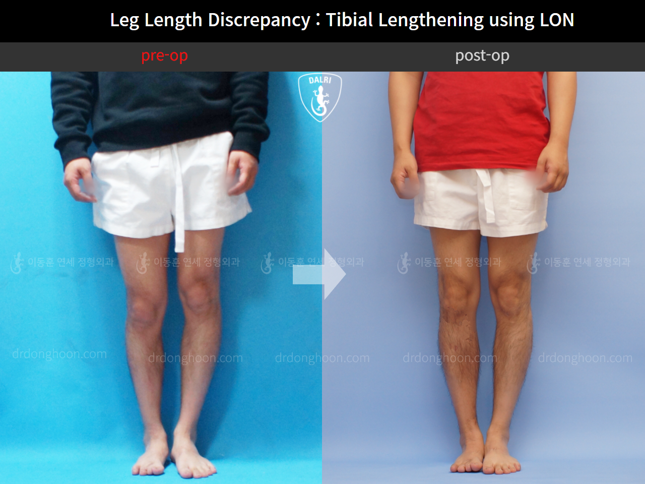 Before and after adult lld, case 11651115, image 3, Dr. Donghoon institute (DALRI)