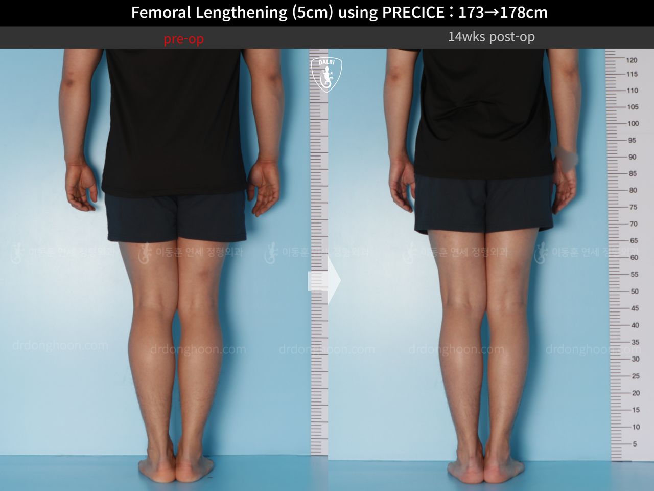 Before and after cll precice, case 14448457, image 6, Dr. Donghoon institute (DALRI)