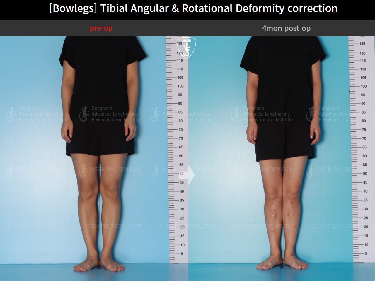 Before and after adult bowlegs, case 16530390, image 3, Dr. Donghoon institute (DALRI)