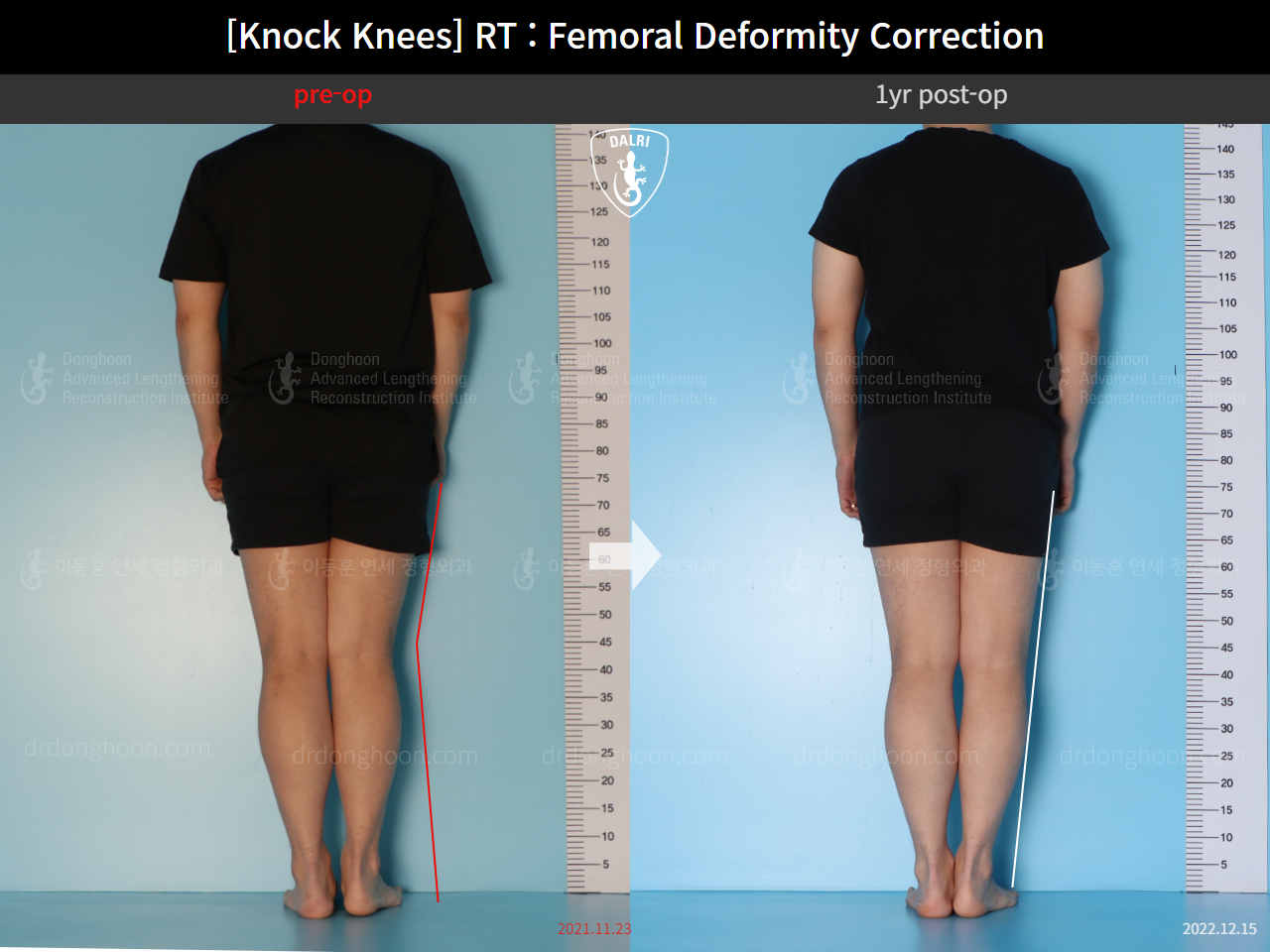 Before and after adult knock knees, case 15950751, image 5, Dr. Donghoon institute (DALRI)