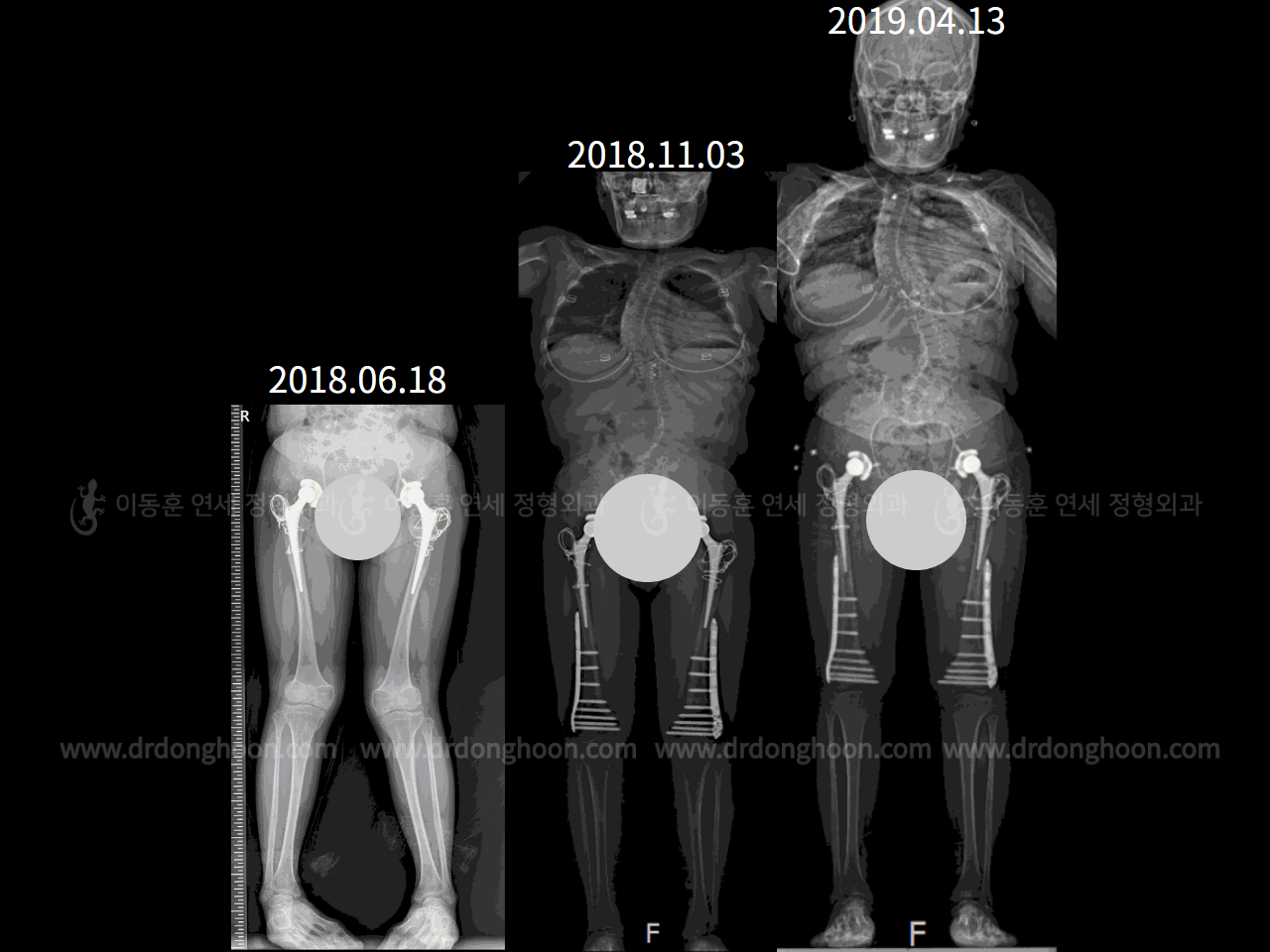 Before and after congenital condition, case 4300063, image 3, Dr. Donghoon institute (DALRI)
