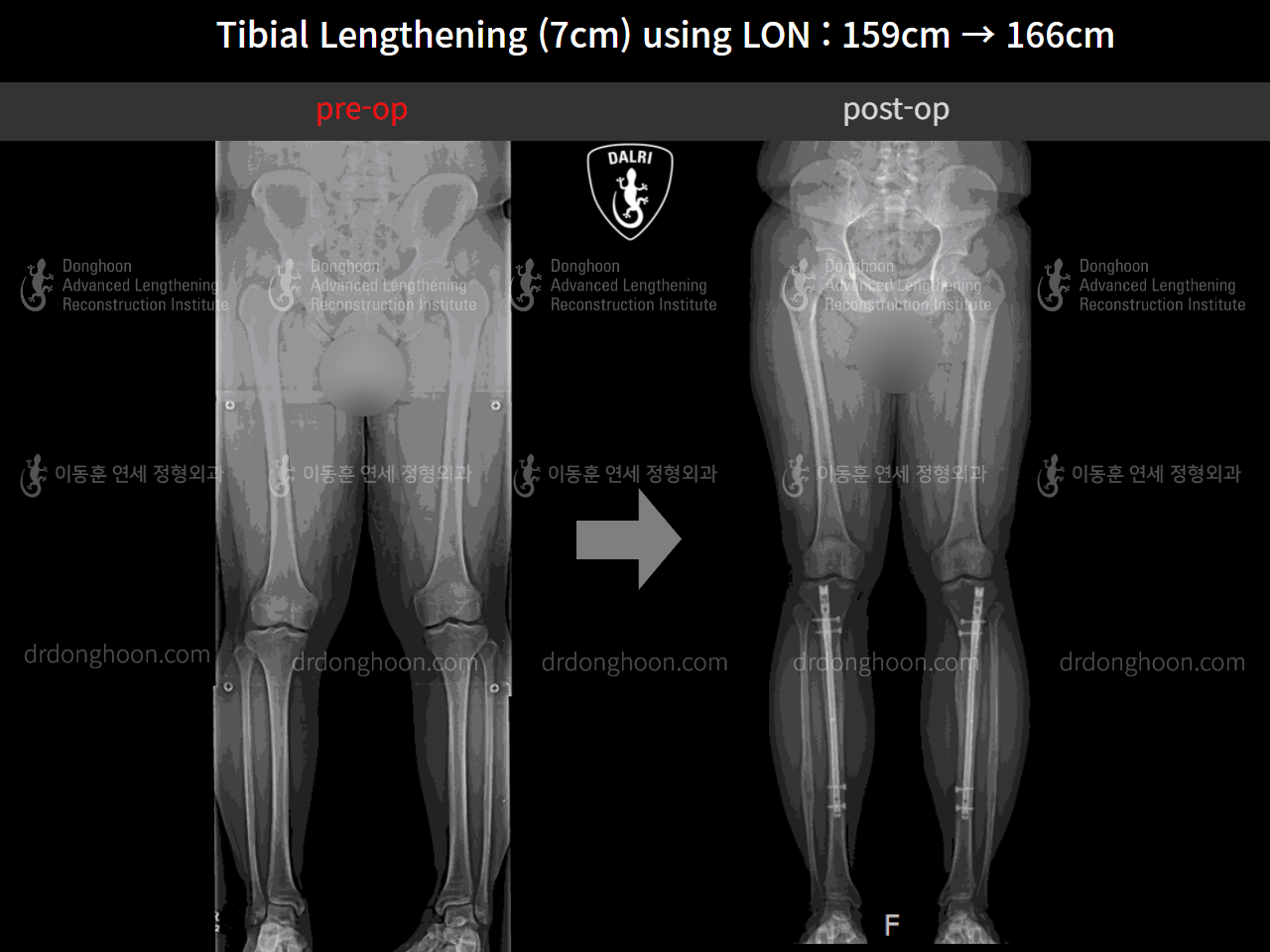 Before and after cll lon, case 9869704, image 5, Dr. Donghoon institute (DALRI)