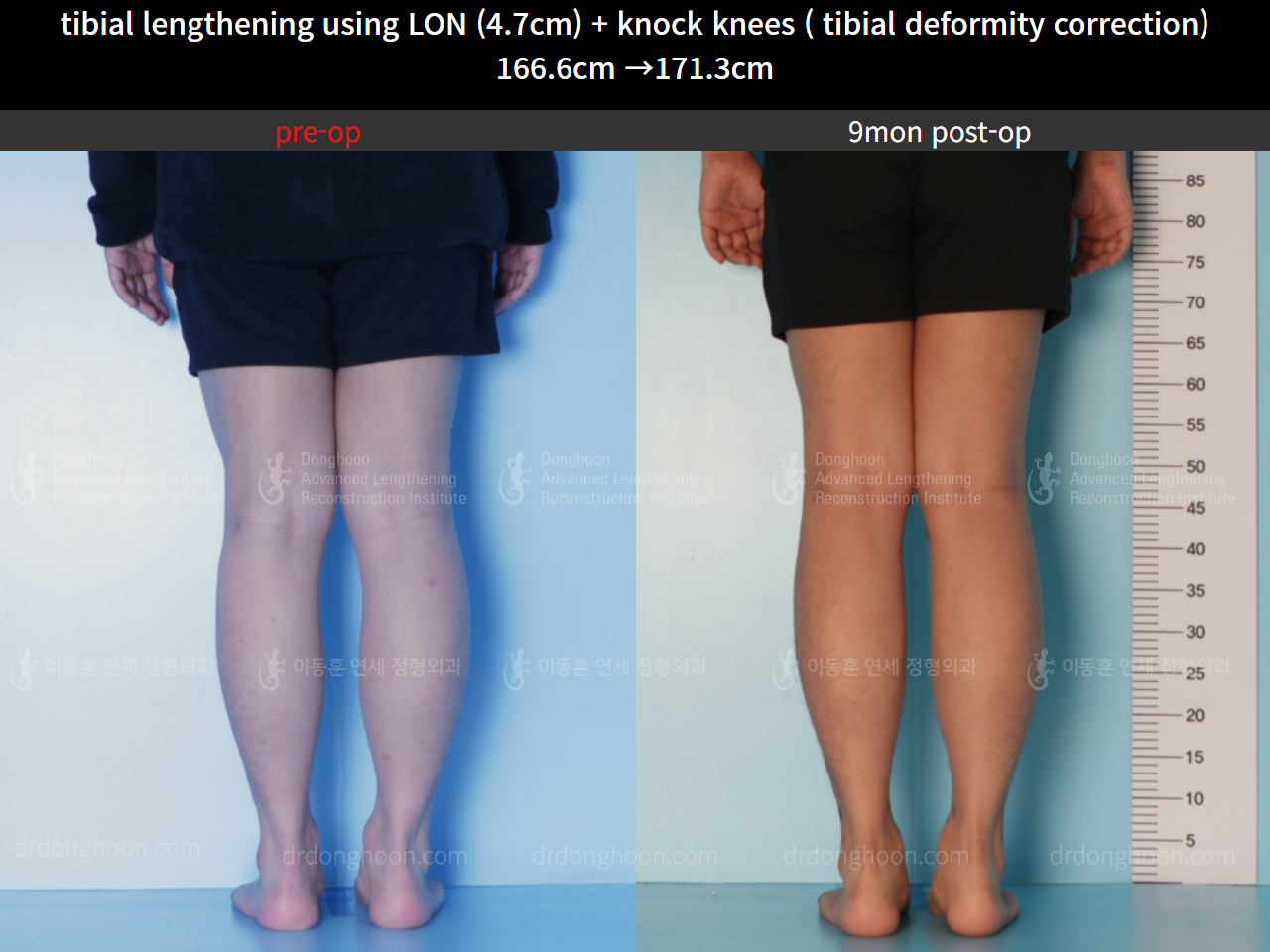 Before and after cll + deformity correction, case 8583829, image 6, Dr. Donghoon institute (DALRI)