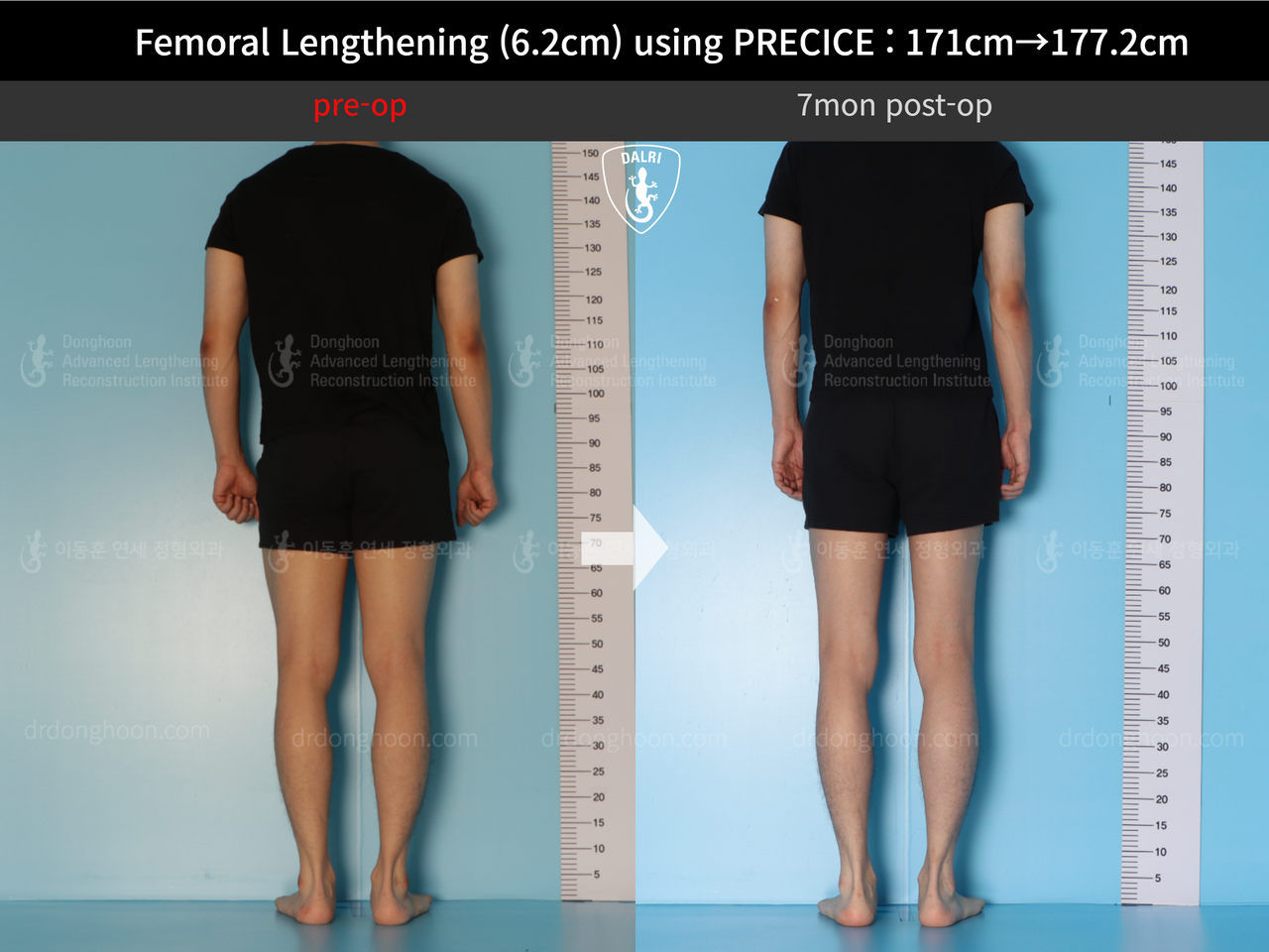 Before and after cll precice, case 13325833, image 4, Dr. Donghoon institute (DALRI)
