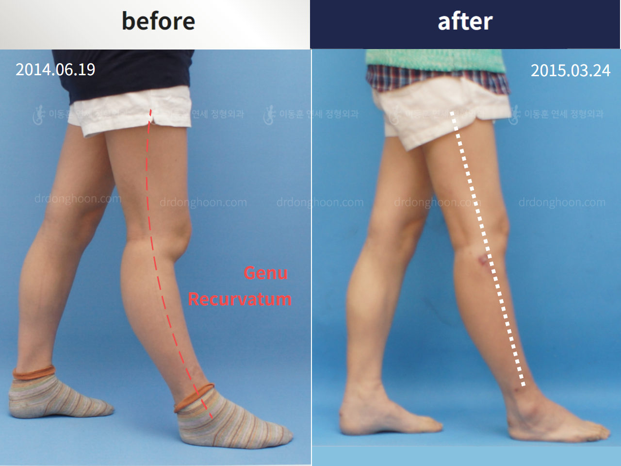 Before and after complex deformity, case 4251572, image 2, Dr. Donghoon institute (DALRI)