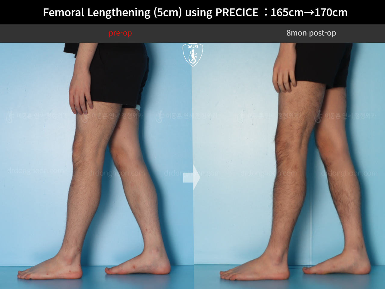 Before and after cll precice, case 18356944, image 9, Dr. Donghoon institute (DALRI)