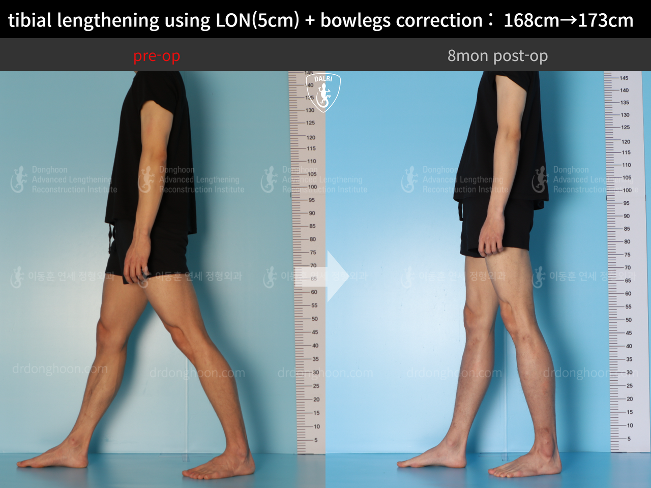 Before and after cll lon, case 13661175, image 6, Dr. Donghoon institute (DALRI)
