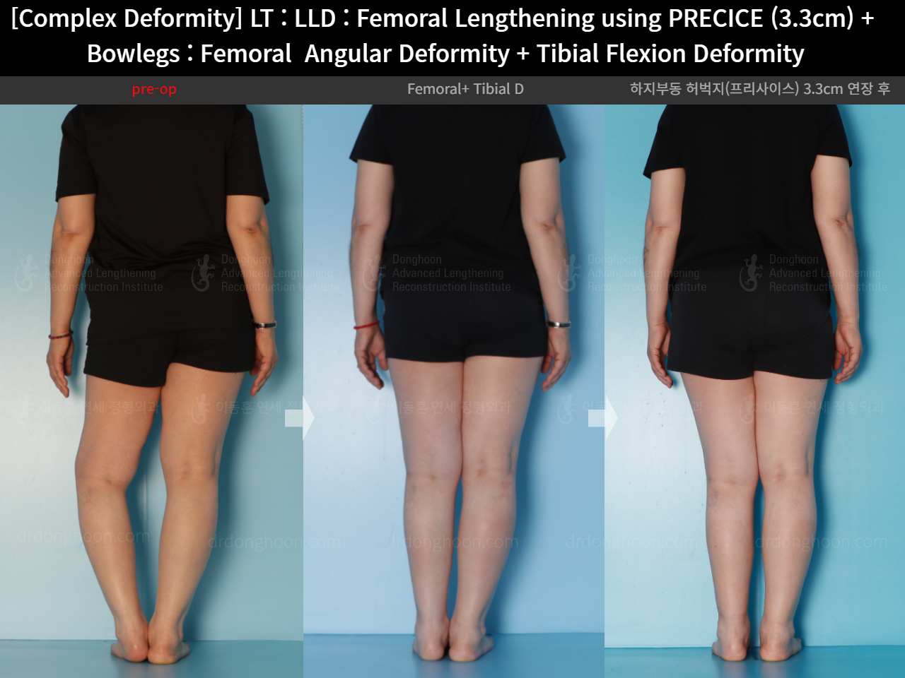 Before and after adult lld, case 16786688, image 3, Dr. Donghoon institute (DALRI)