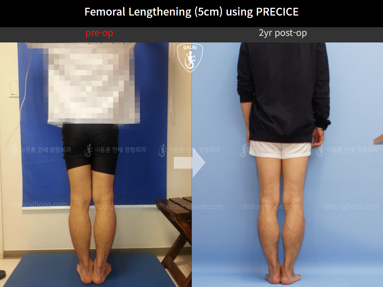 Before and after cll precice, case 4323372, image 2, Dr. Donghoon institute (DALRI)
