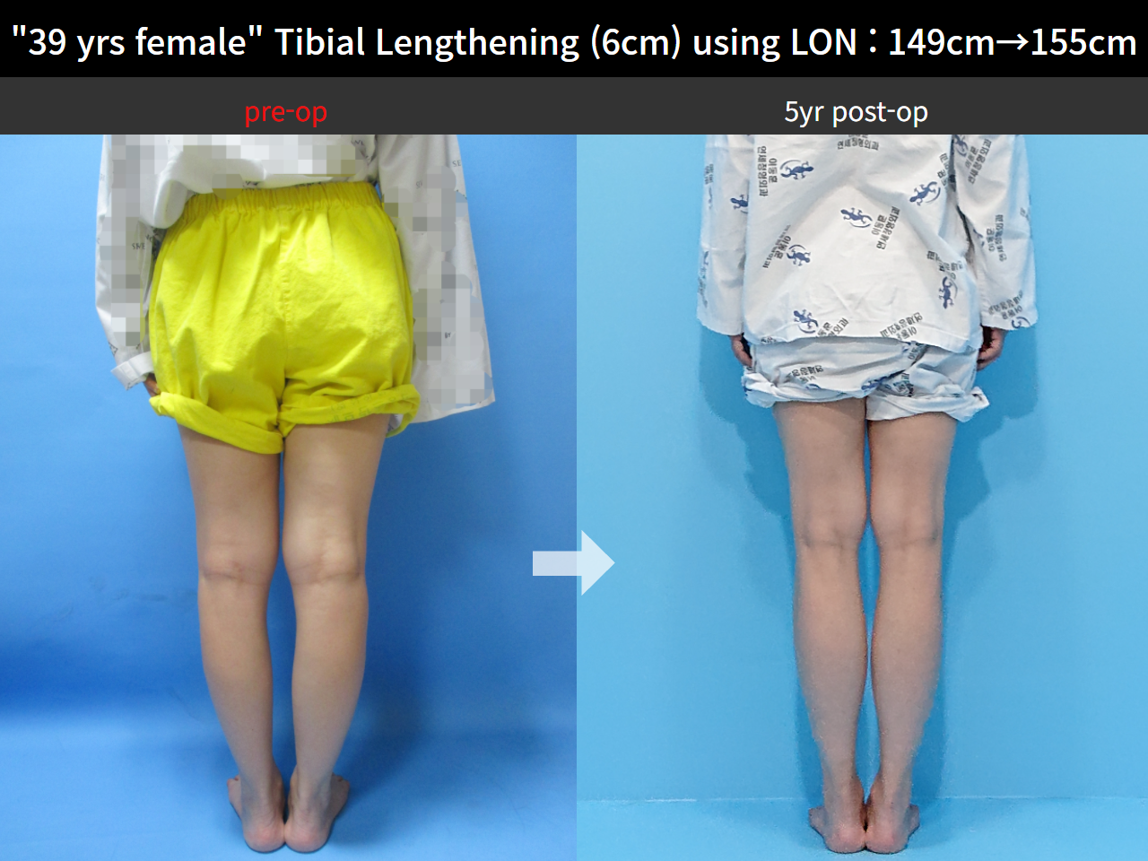 Before and after cll lon, case 8626950, image 2, Dr. Donghoon institute (DALRI)