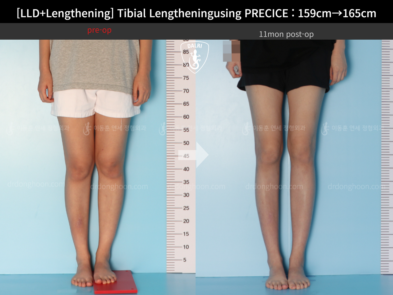 Before and after cll precice, case 13252418, image 5, Dr. Donghoon institute (DALRI)