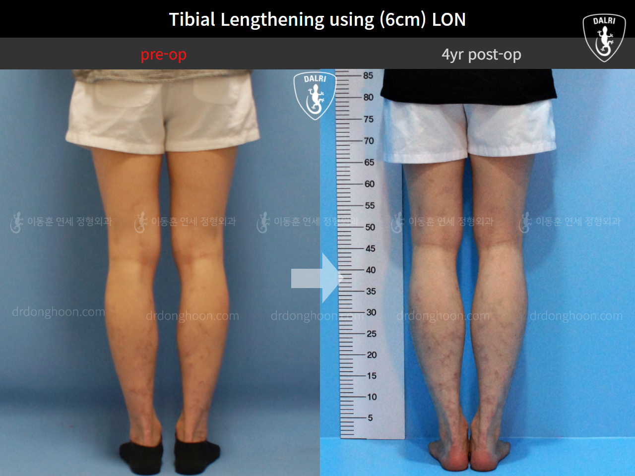 Before and after cll lon, case 4323452, image 6, Dr. Donghoon institute (DALRI)