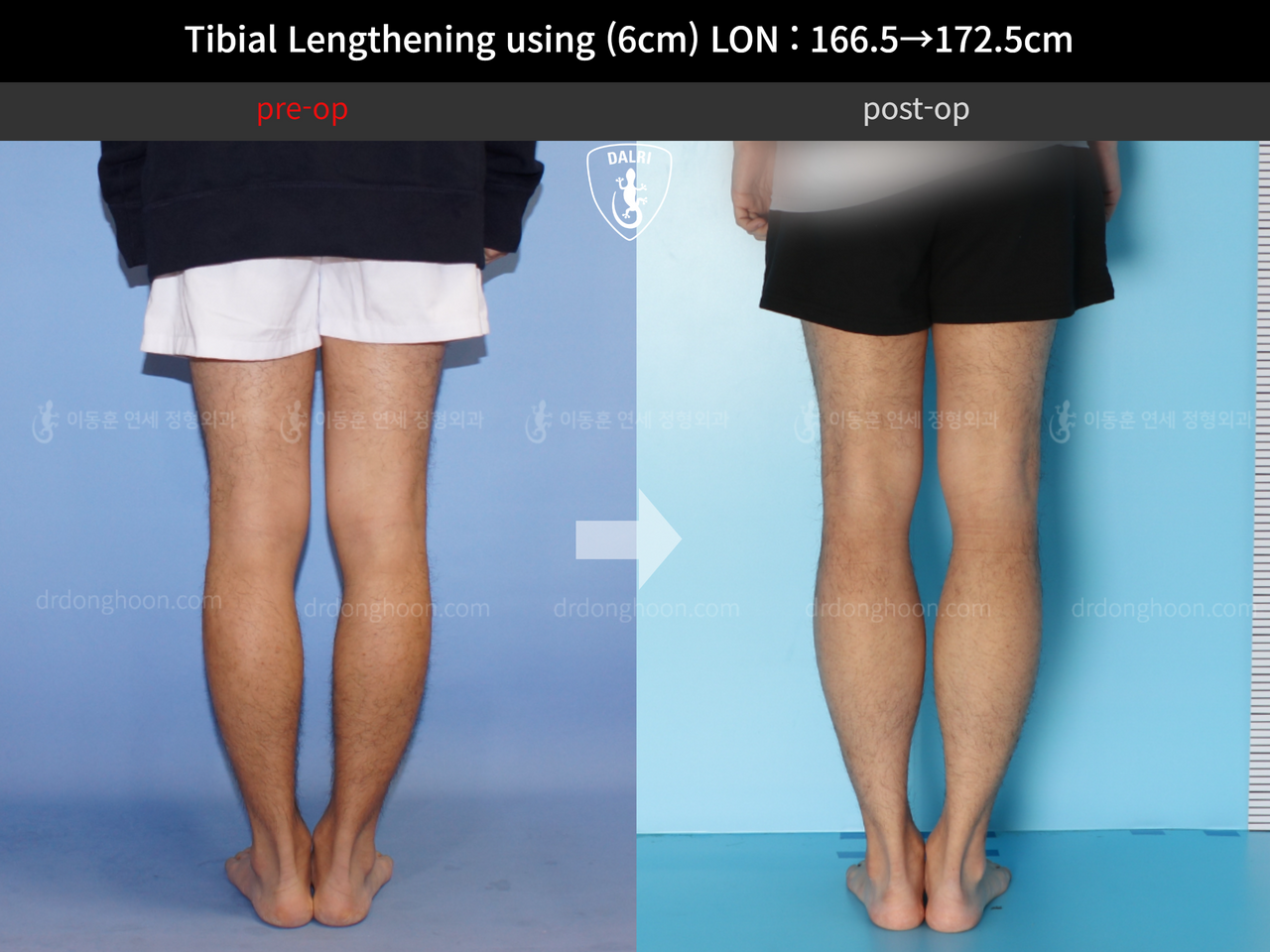 Before and after cll lon, case 11980239, image 6, Dr. Donghoon institute (DALRI)