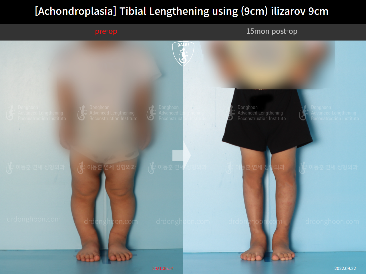 Before and after paediatric congenital condition, case 14542054, image 1, Dr. Donghoon institute (DALRI)