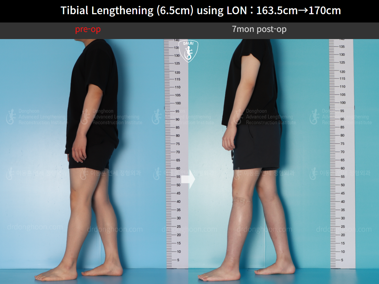 Before and after cll lon, case 17199046, image 3, Dr. Donghoon institute (DALRI)