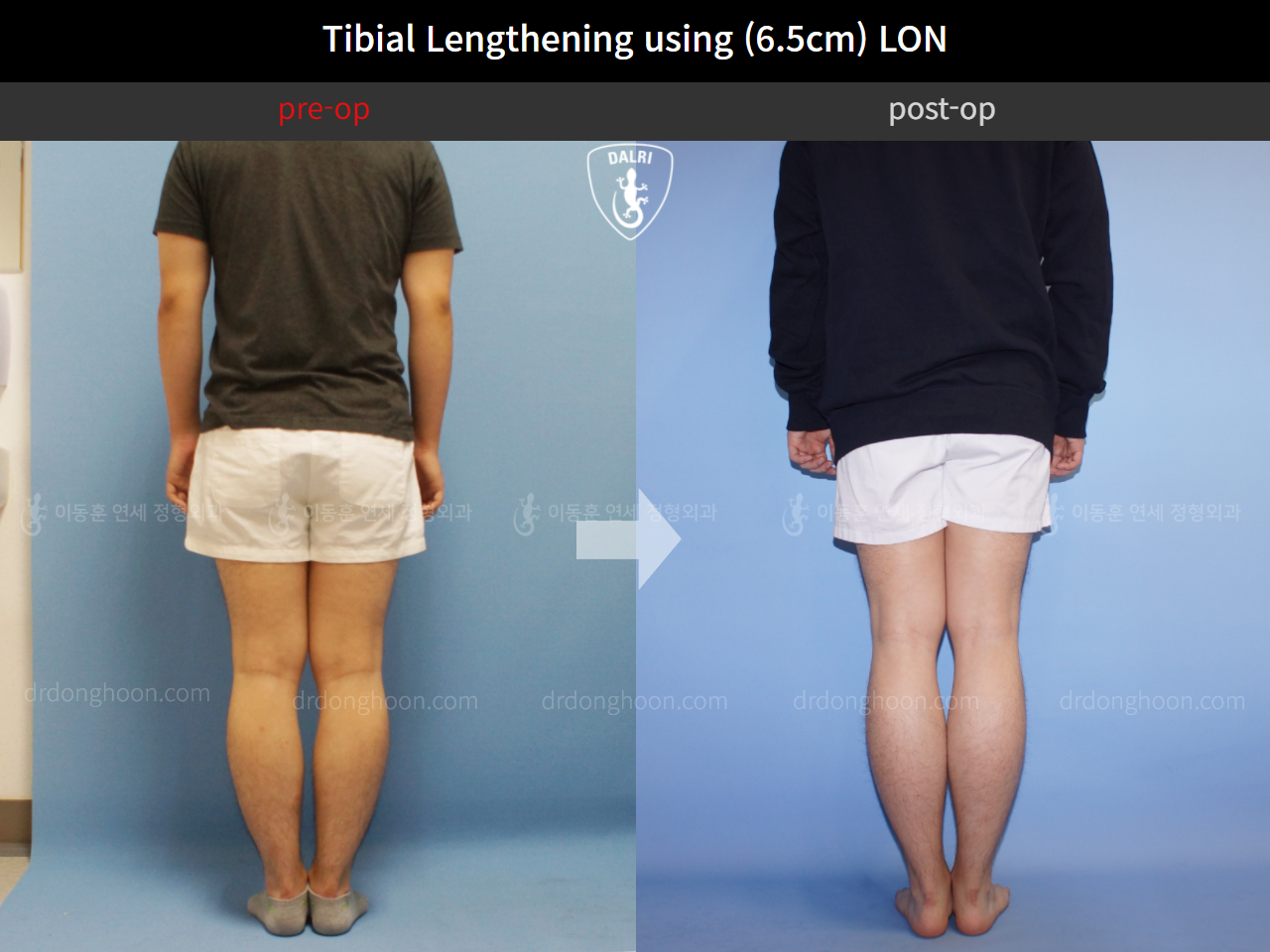 Before and after cll lon, case 4323455, image 2, Dr. Donghoon institute (DALRI)