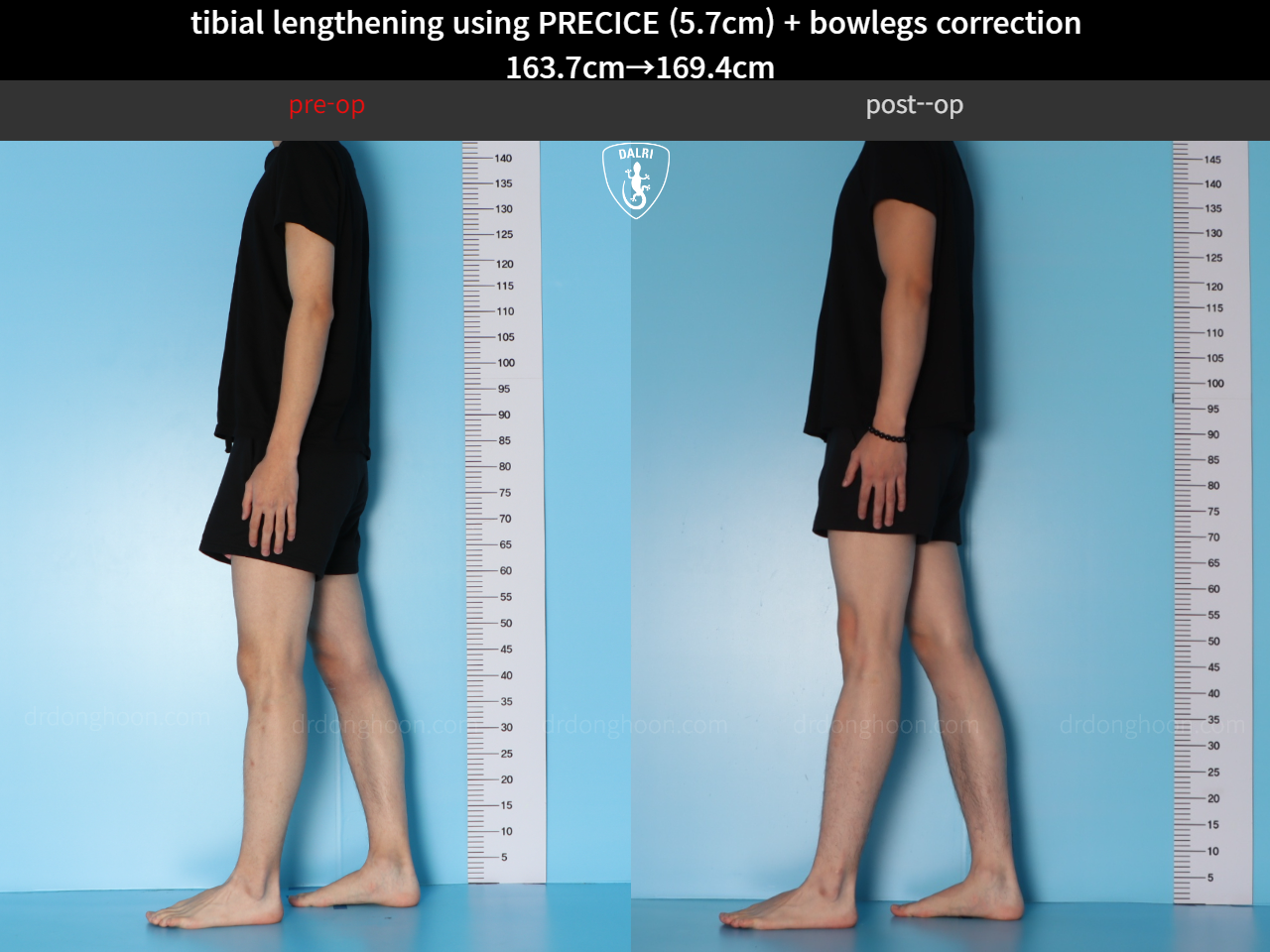 Before and after cll precice, case 38471448, image 3, Dr. Donghoon institute (DALRI)