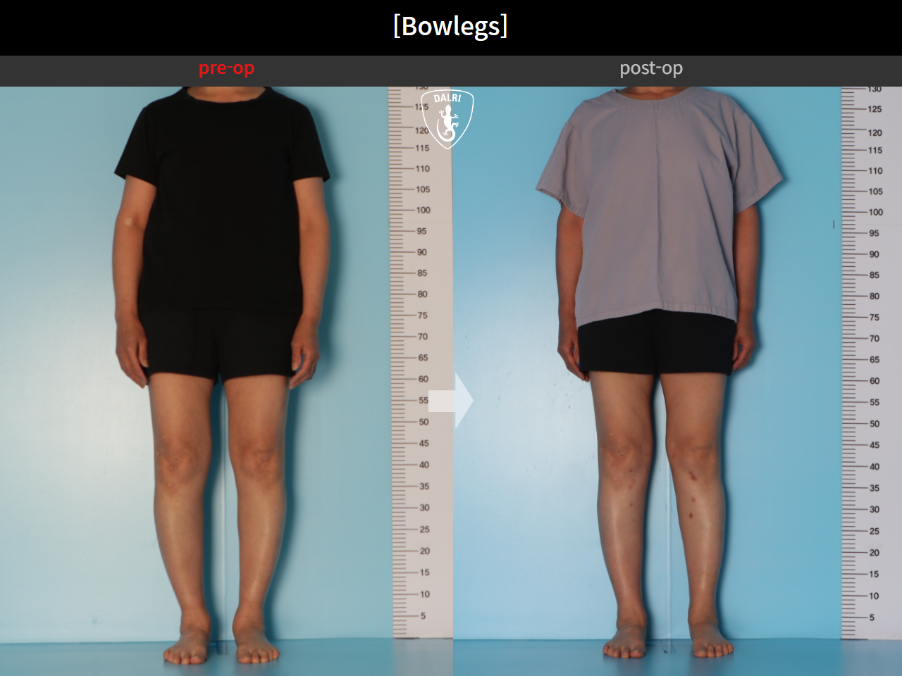 Before and after adult bowlegs, case 30770070, image 2, Dr. Donghoon institute (DALRI)