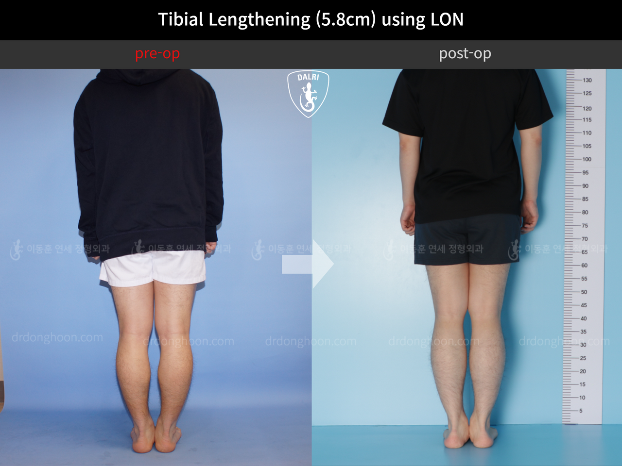 Before and after cll lon, case 4577732, image 2, Dr. Donghoon institute (DALRI)