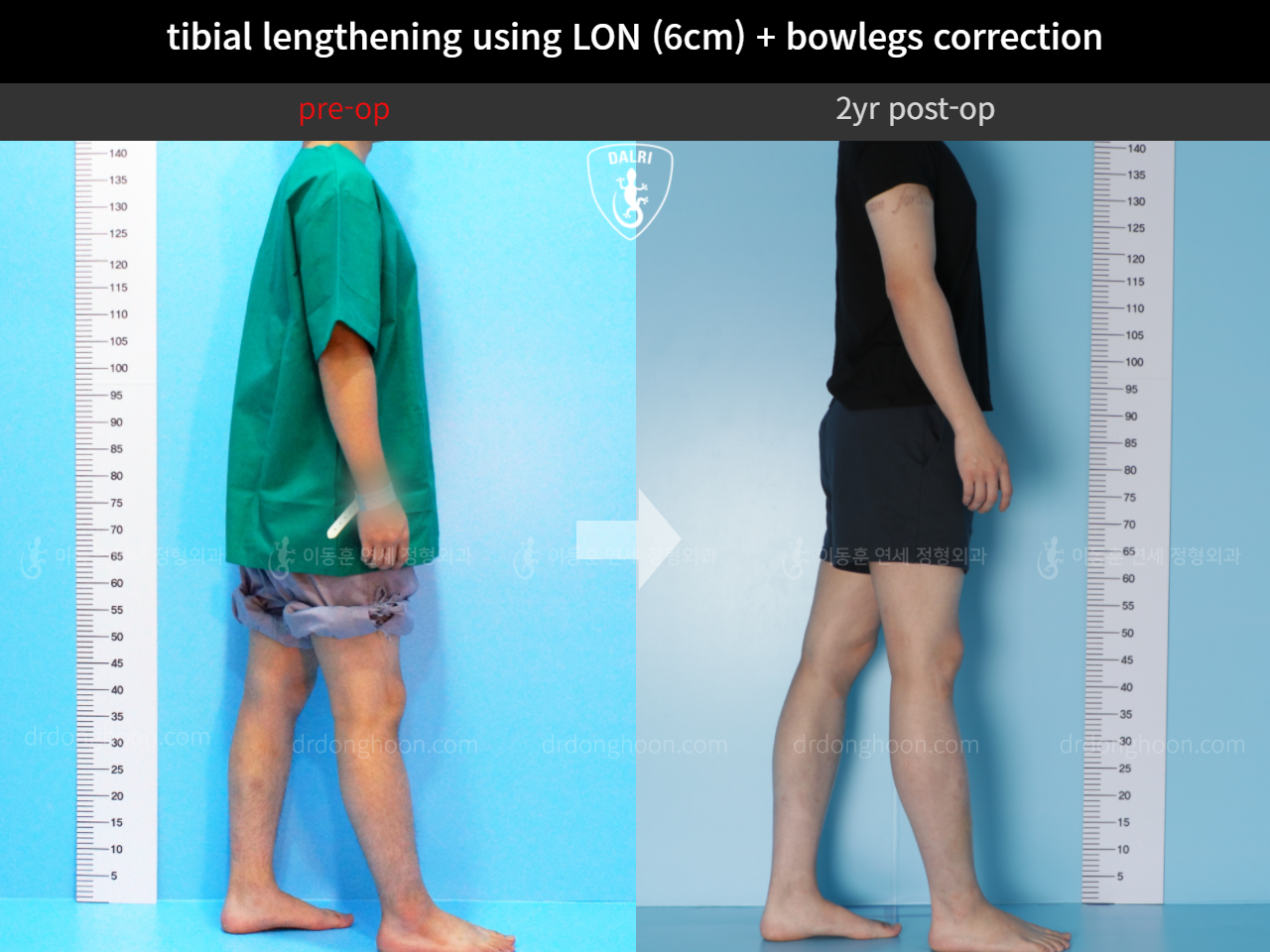 Before and after cll + deformity correction, case 4323141, image 3, Dr. Donghoon institute (DALRI)