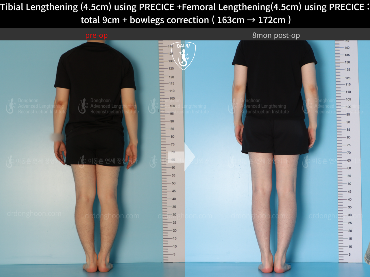 Before and after cll precice, case 13912585, image 3, Dr. Donghoon institute (DALRI)