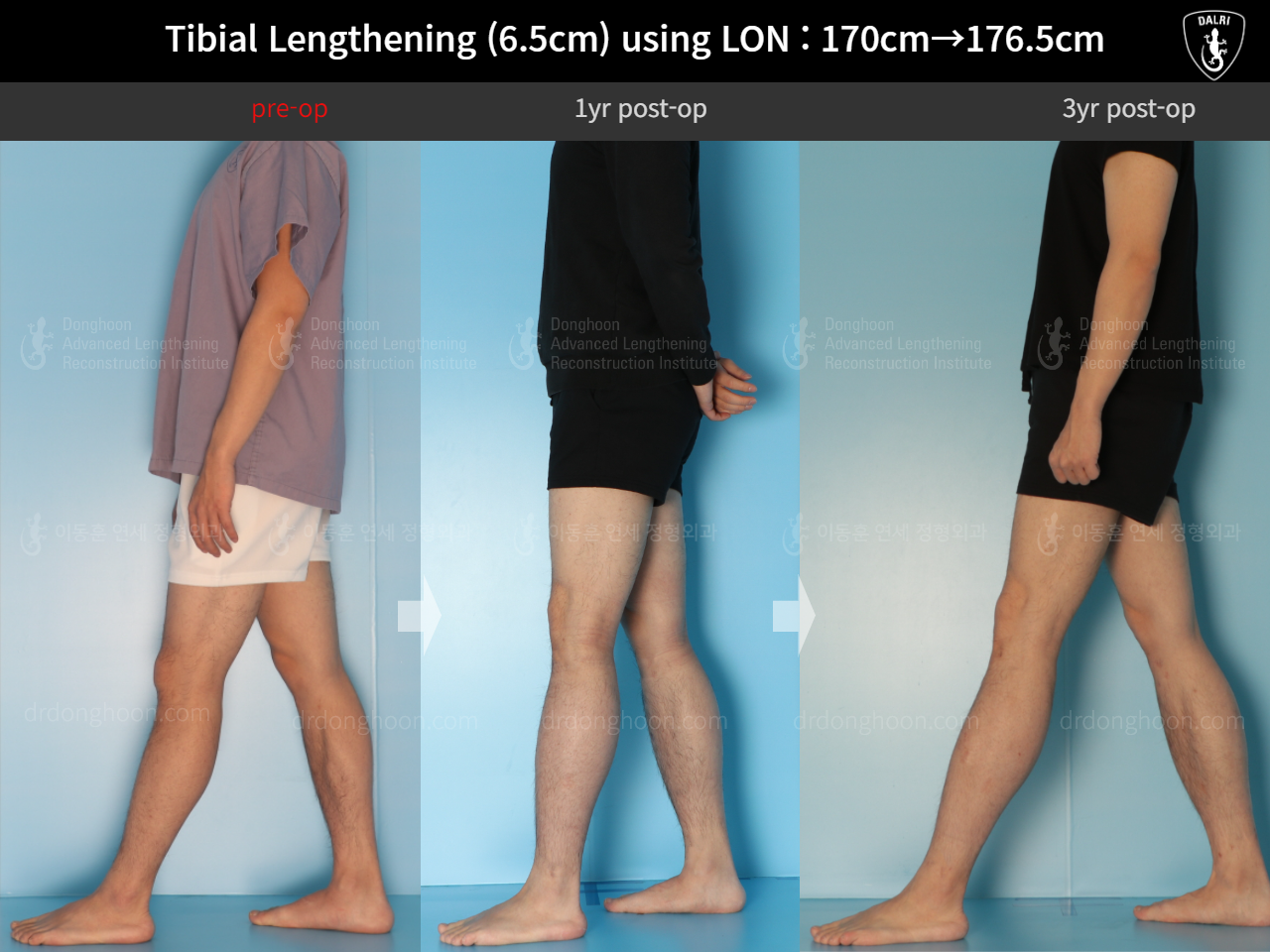 Before and after cll lon, case 16299082, image 3, Dr. Donghoon institute (DALRI)