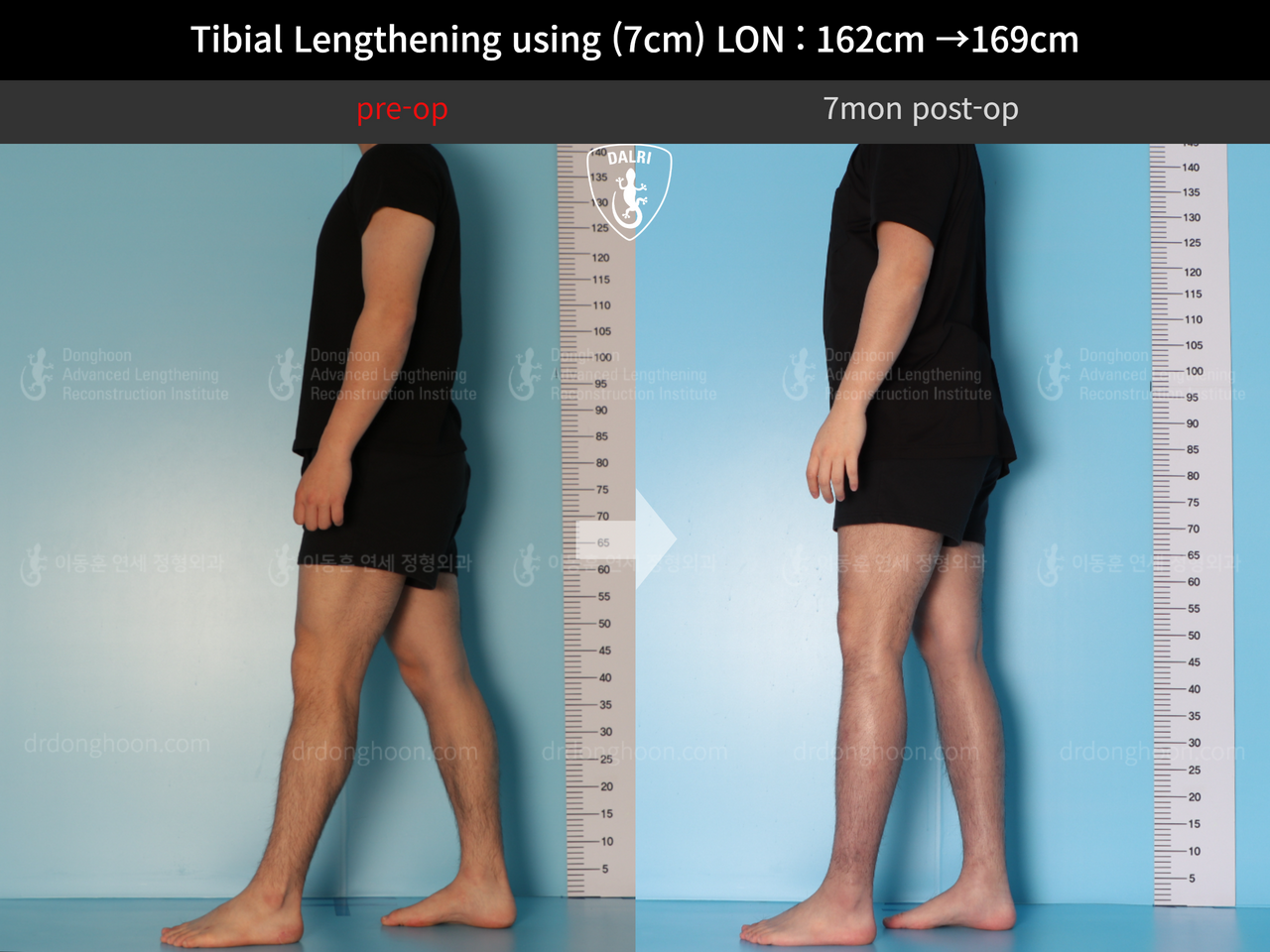 Before and after cll lon, case 13743472, image 7, Dr. Donghoon institute (DALRI)