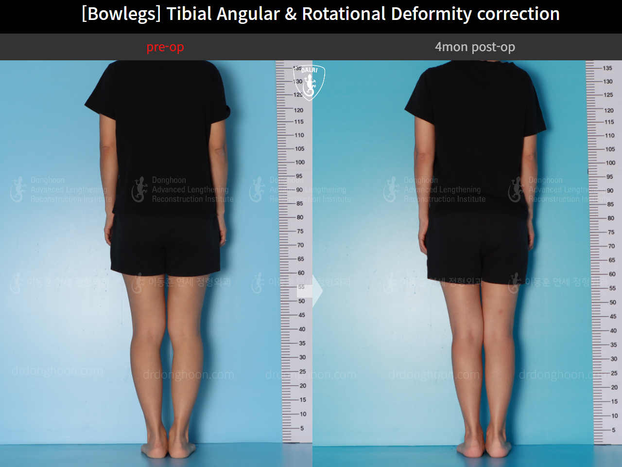 Before and after adult bowlegs, case 16530390, image 4, Dr. Donghoon institute (DALRI)