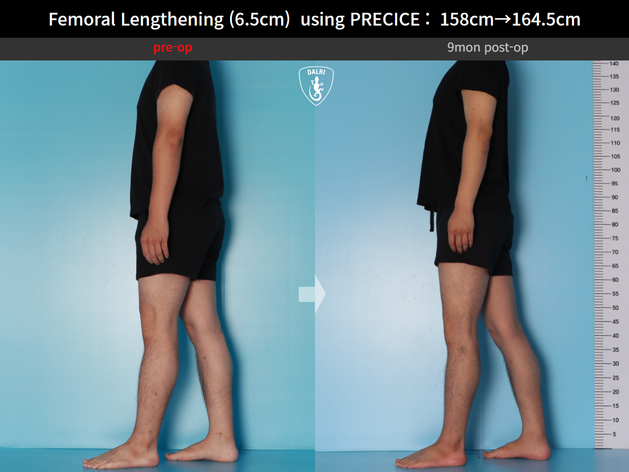Before and after cll precice, case 28297898, image 3, Dr. Donghoon institute (DALRI)