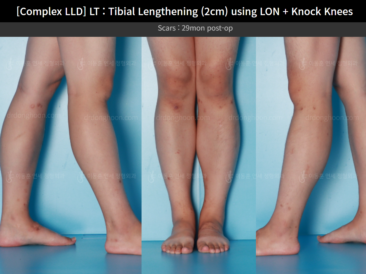 Before and after adult lld, case 16165477, image 7, Dr. Donghoon institute (DALRI)