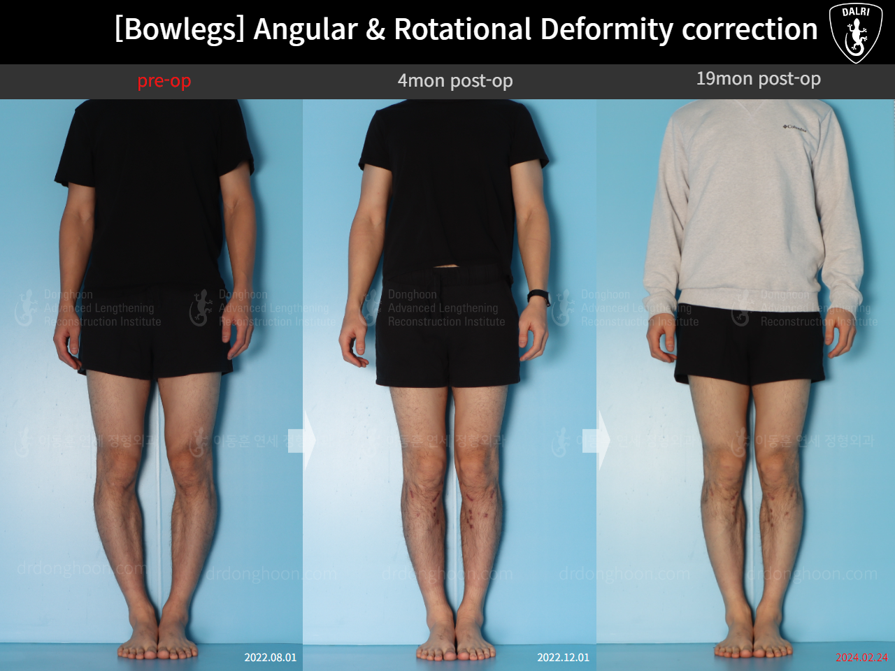 Before and after adult bowlegs, case 18306379, image 1, Dr. Donghoon institute (DALRI)