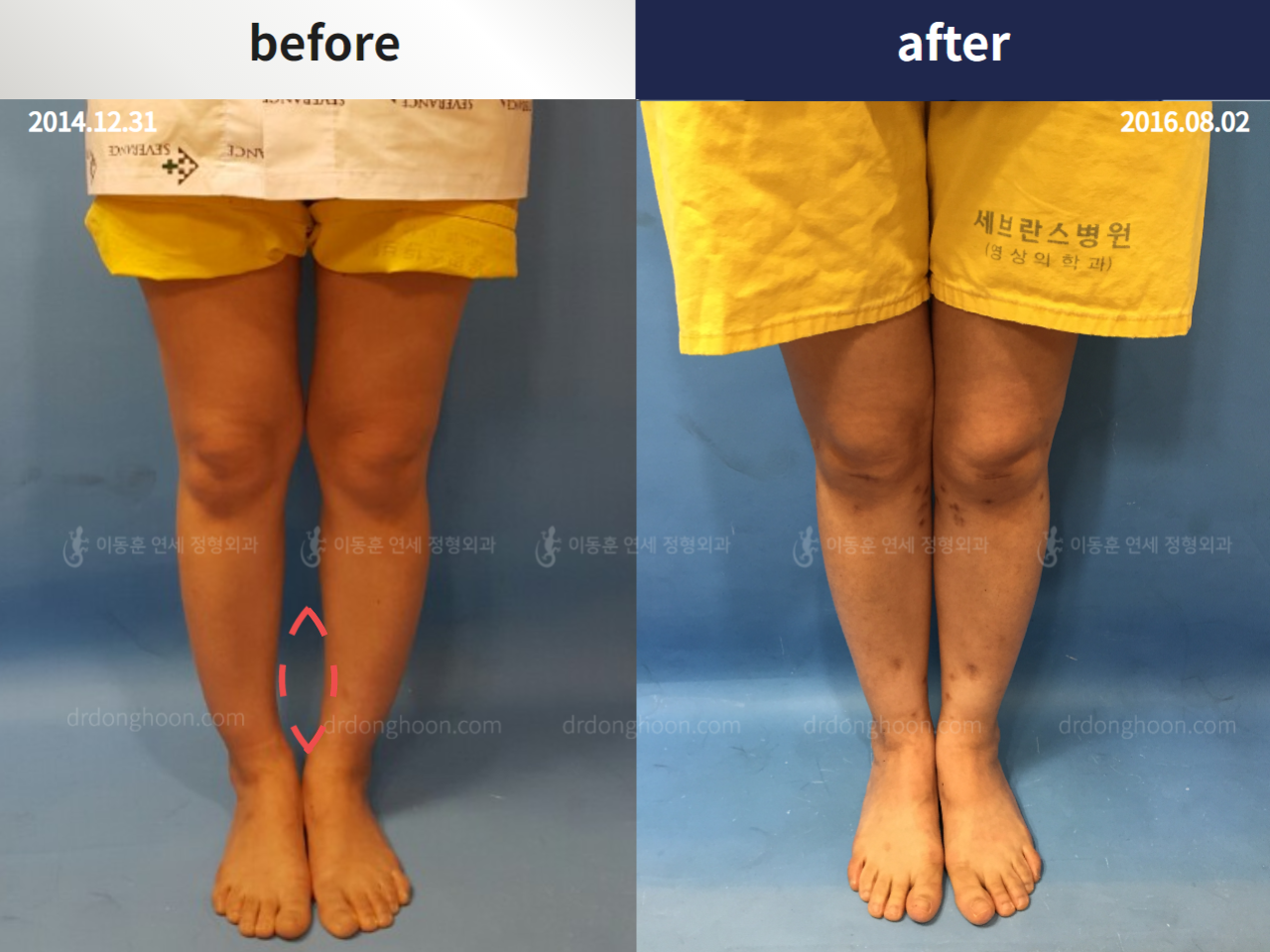 Before and after foot & ankle deformity, case 4248027, image 2, Dr. Donghoon institute (DALRI)