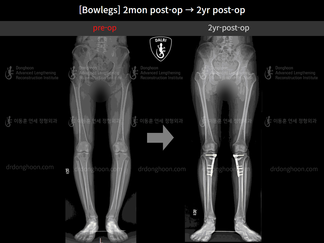 Before and after adult bowlegs, case 4311373, image 7, Dr. Donghoon institute (DALRI)