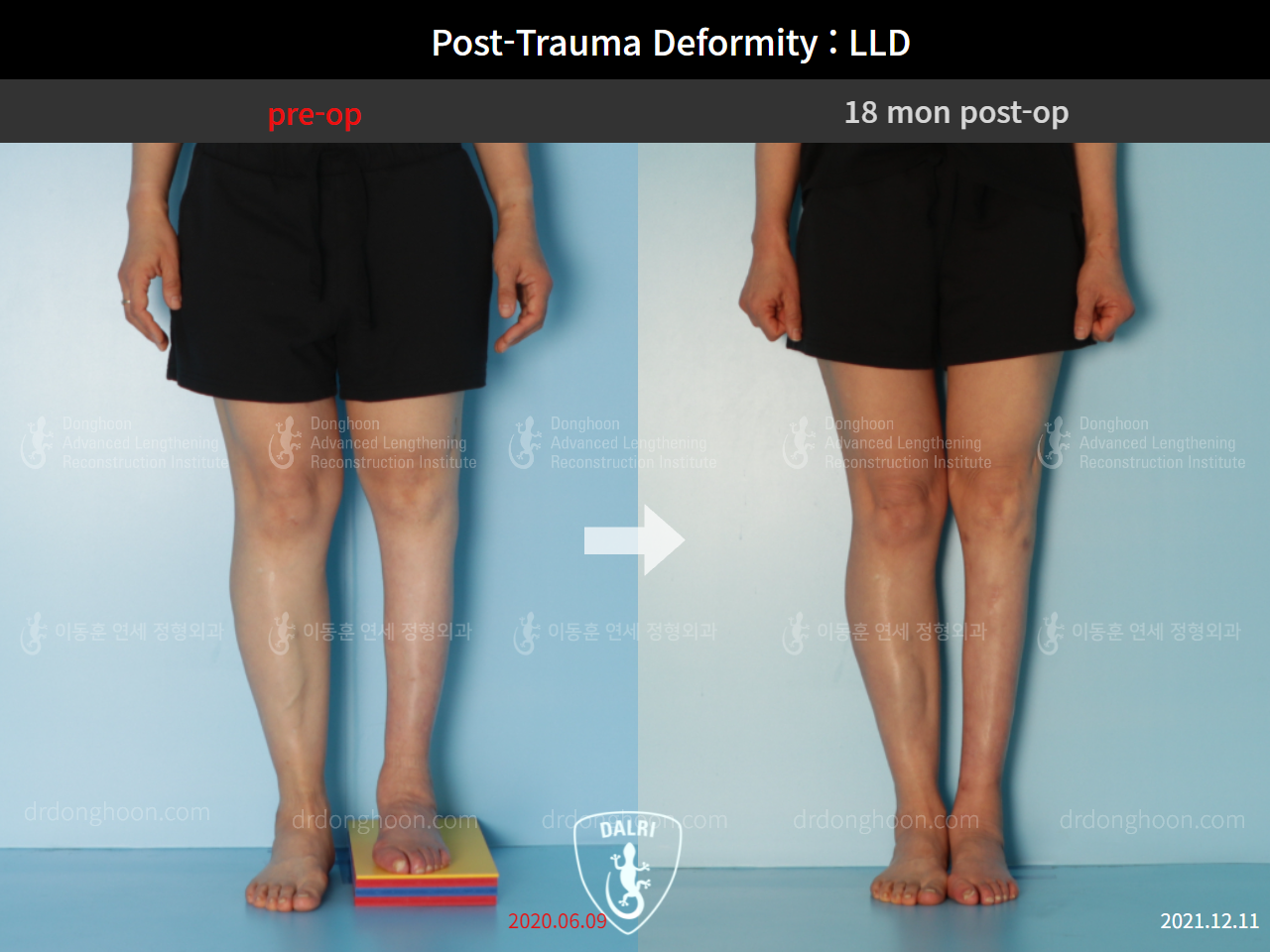 Before and after adult lld, case 9125304, image 5, Dr. Donghoon institute (DALRI)