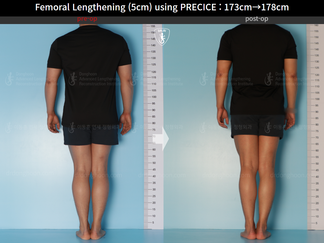 Before and after cll precice, case 21702609, image 4, Dr. Donghoon institute (DALRI)