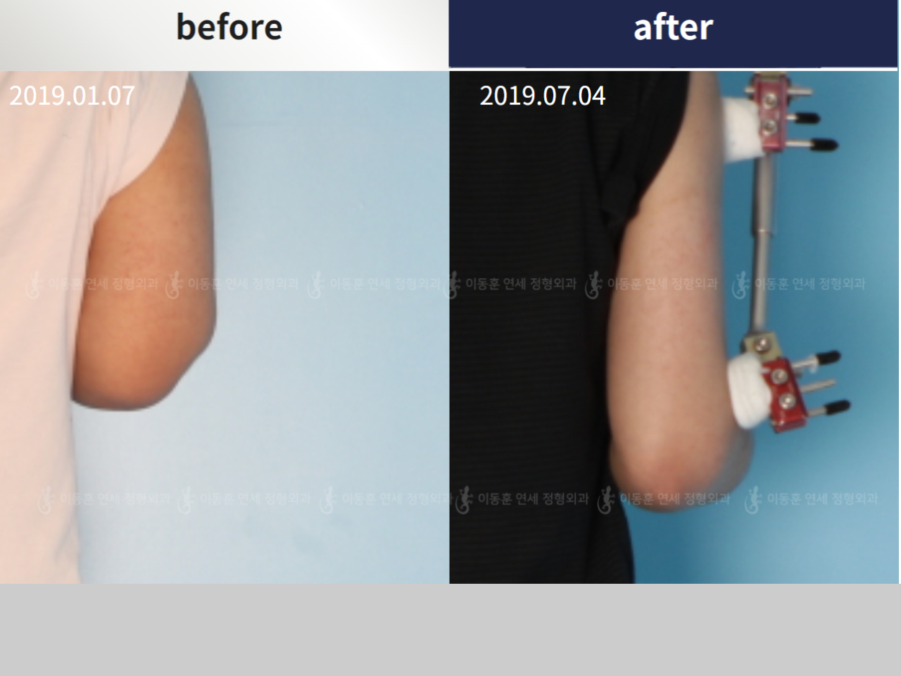 Before and after arm lengthening, case 4249423, image 2, Dr. Donghoon institute (DALRI)
