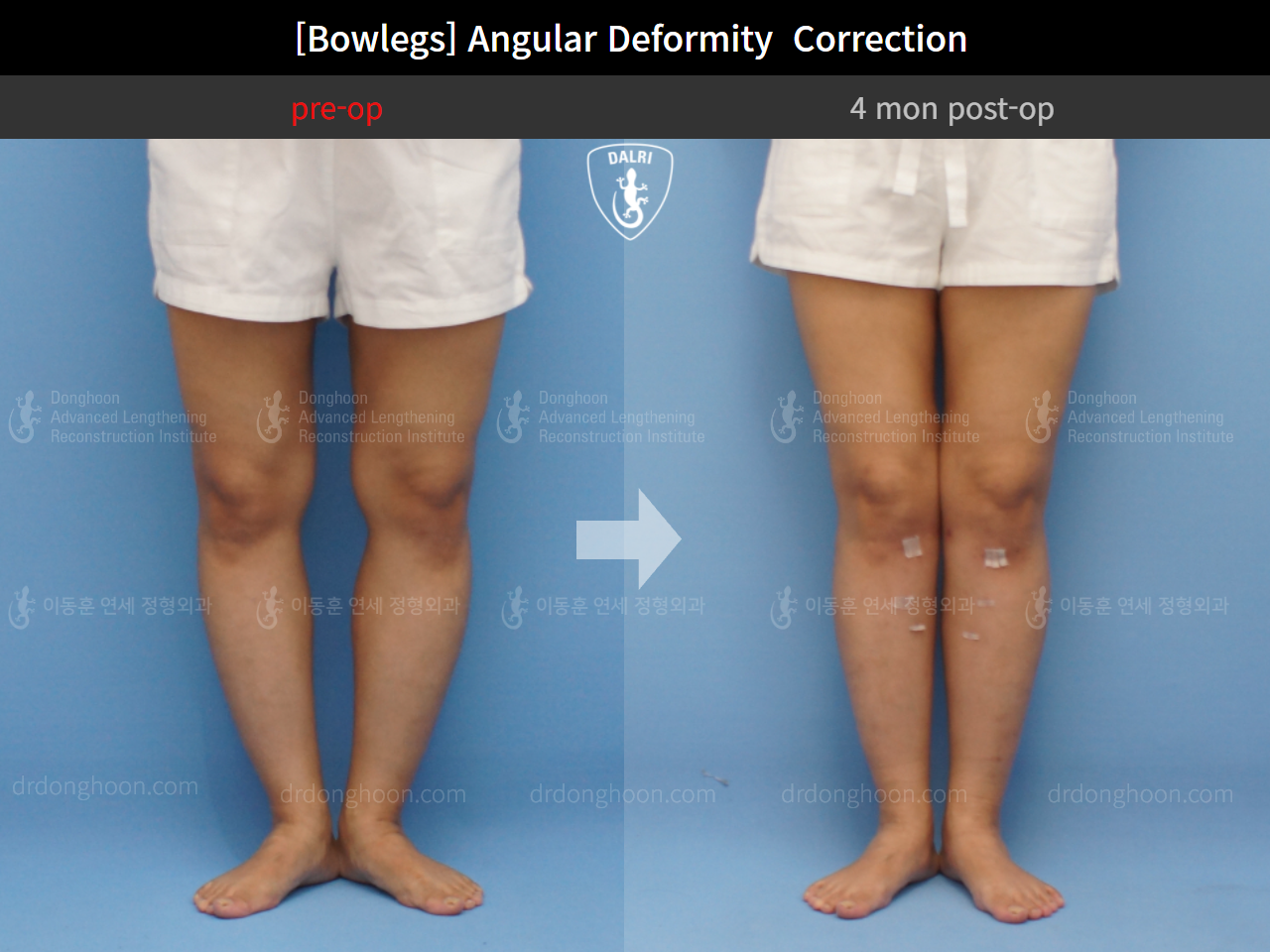 Before and after adult bowlegs, case 9289009, image 6, Dr. Donghoon institute (DALRI)