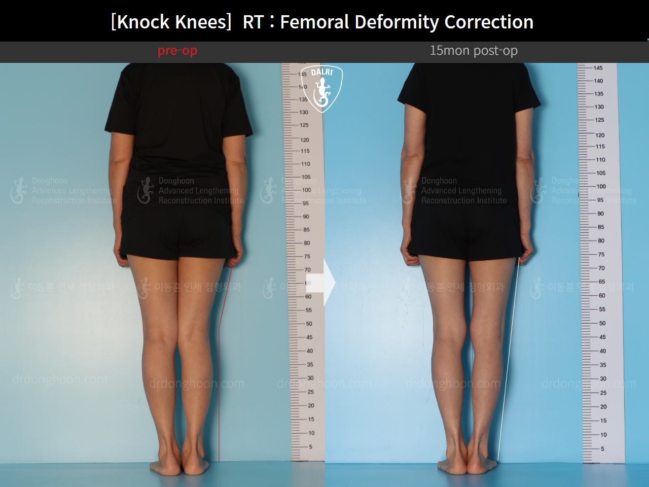 Before and after adult knock knees, case 14462642, image 5, Dr. Donghoon institute (DALRI)
