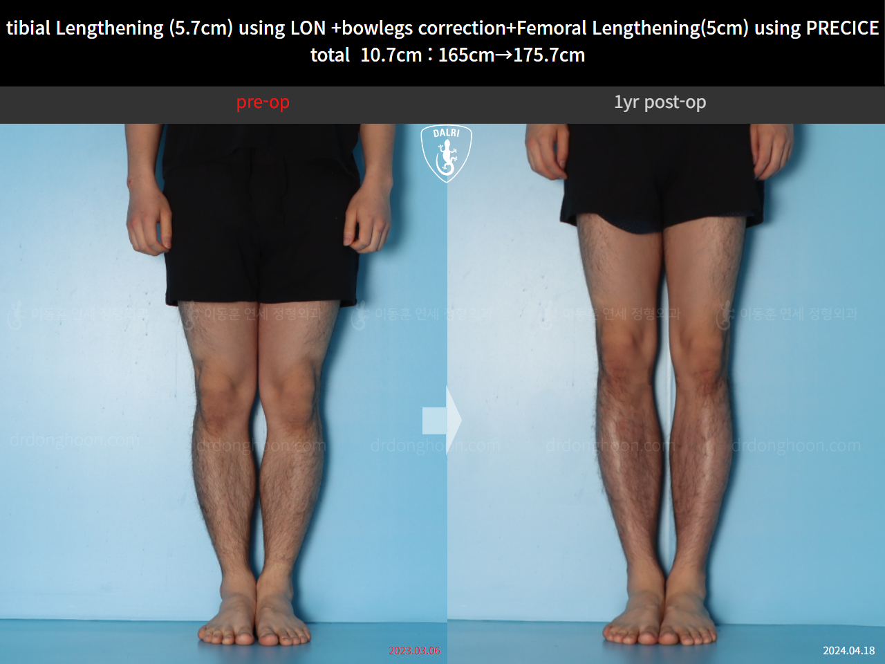 Before and after cll precice, case 20363375, image 7, Dr. Donghoon institute (DALRI)