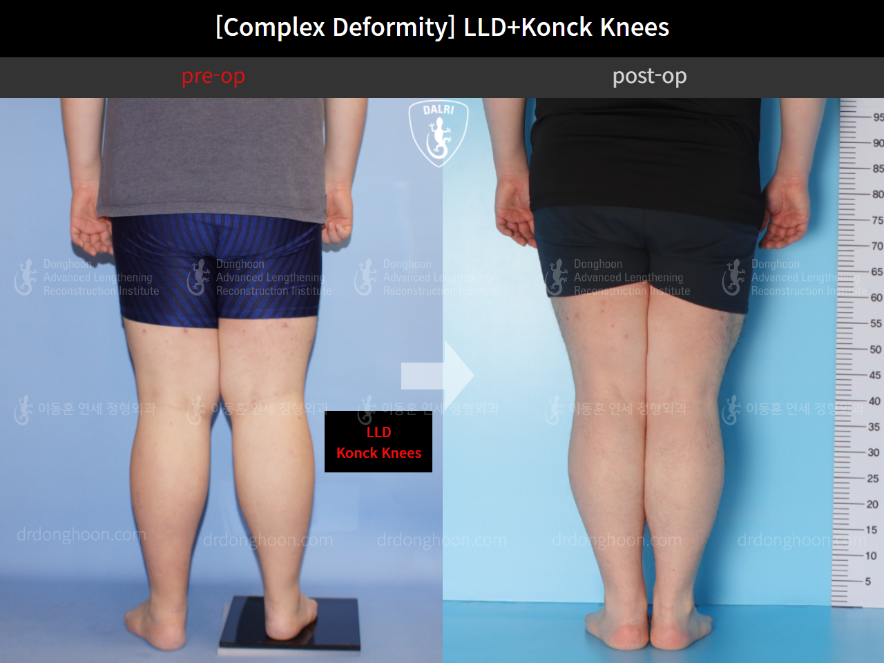 Before and after complex deformity, case 10564251, image 5, Dr. Donghoon institute (DALRI)