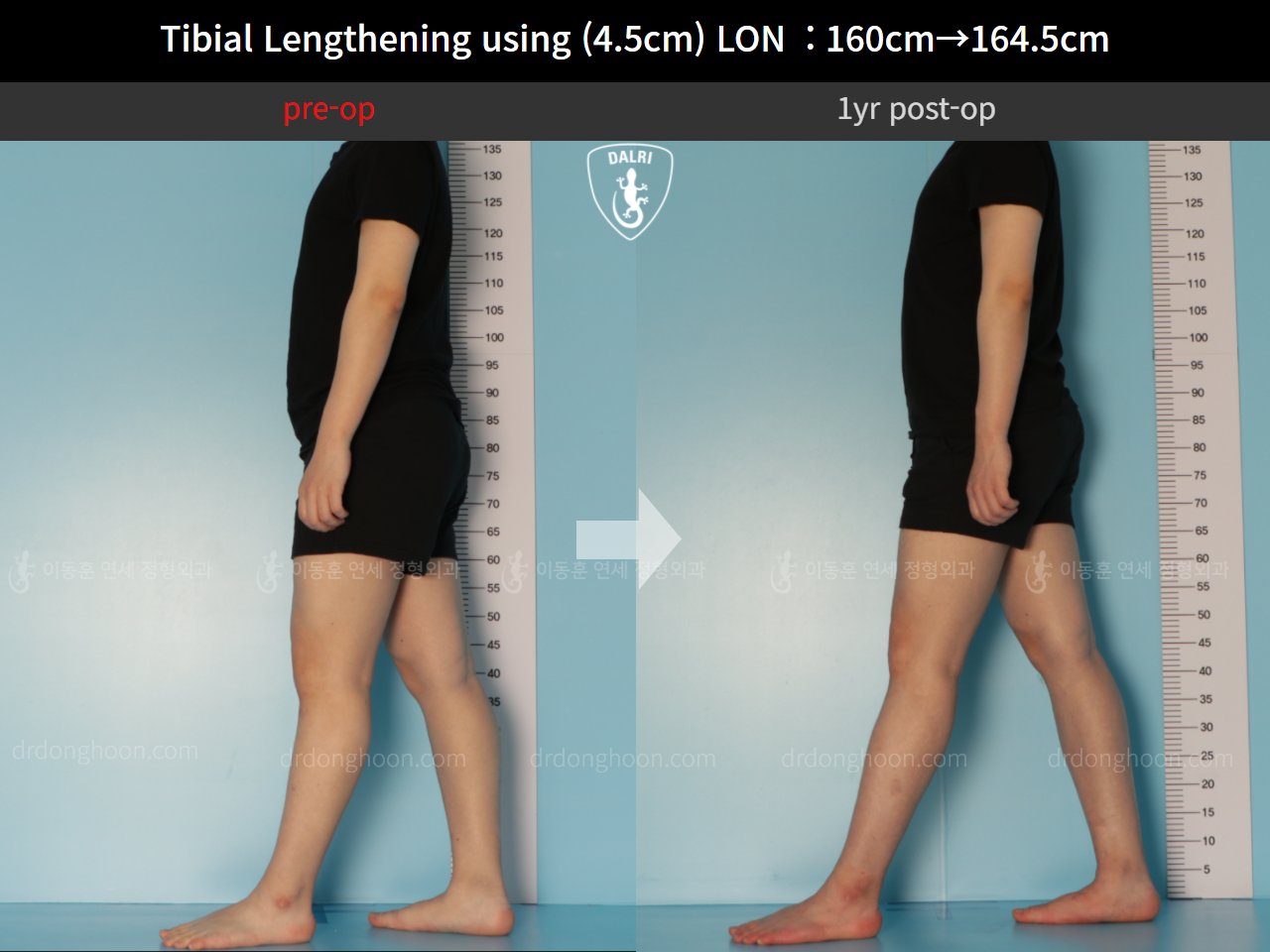 Before and after cll lon, case 10600029, image 3, Dr. Donghoon institute (DALRI)