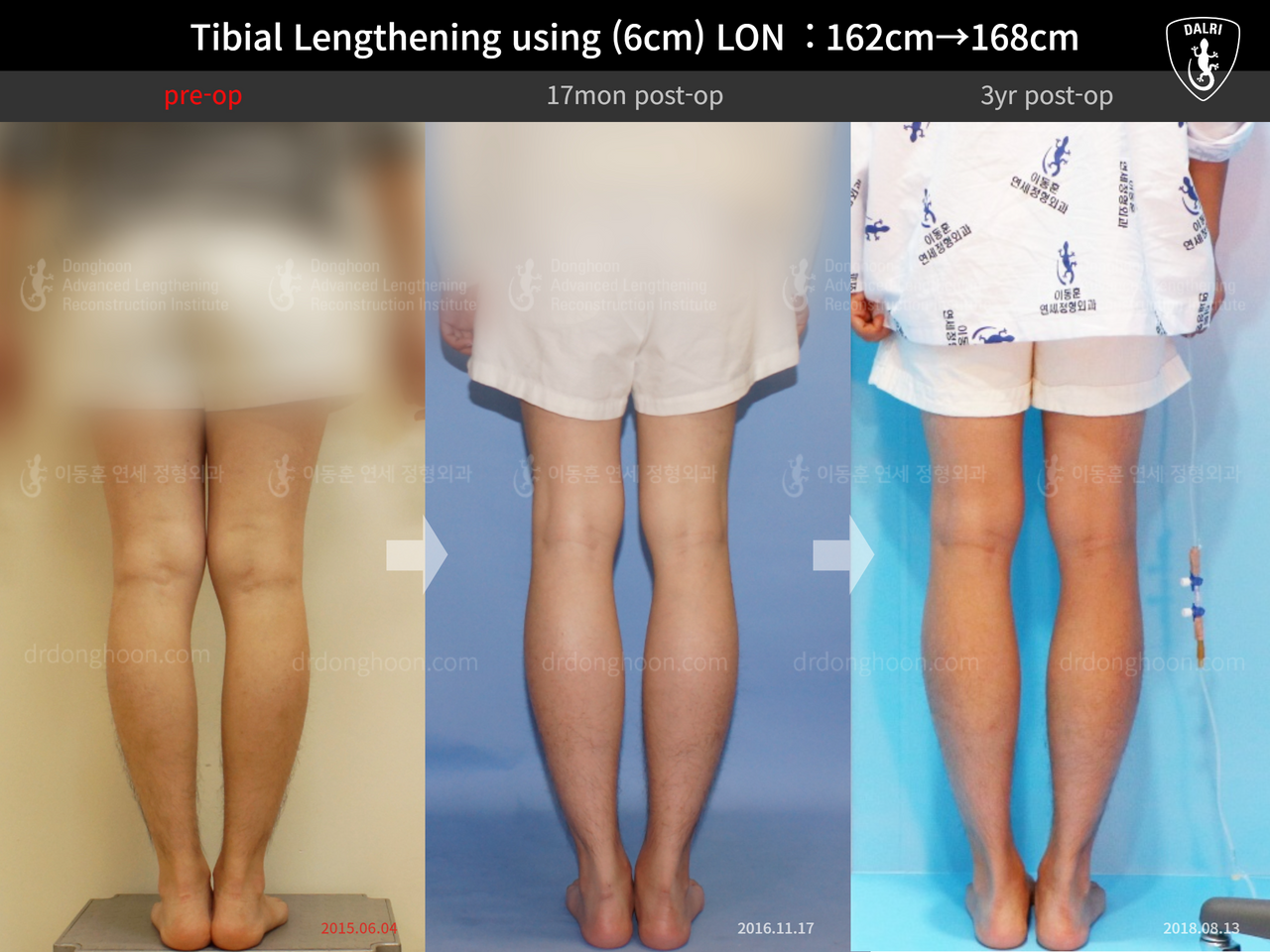 ภาพก่อน-หลัง ยืดขาเทคนิค LON เคสที่ 13552941 ภาพที่ 2 จากโรงพยาบาลศัลยกรรมกระดูกลีดงฮุน (DALRI)