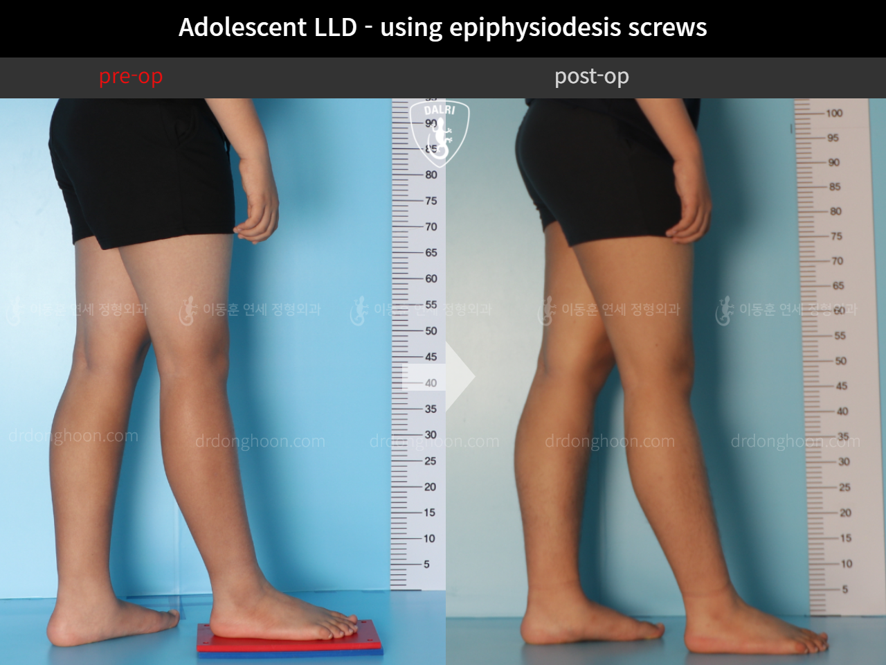 Before and after paediatric & adolescent lld, case 11472870, image 7, Dr. Donghoon institute (DALRI)