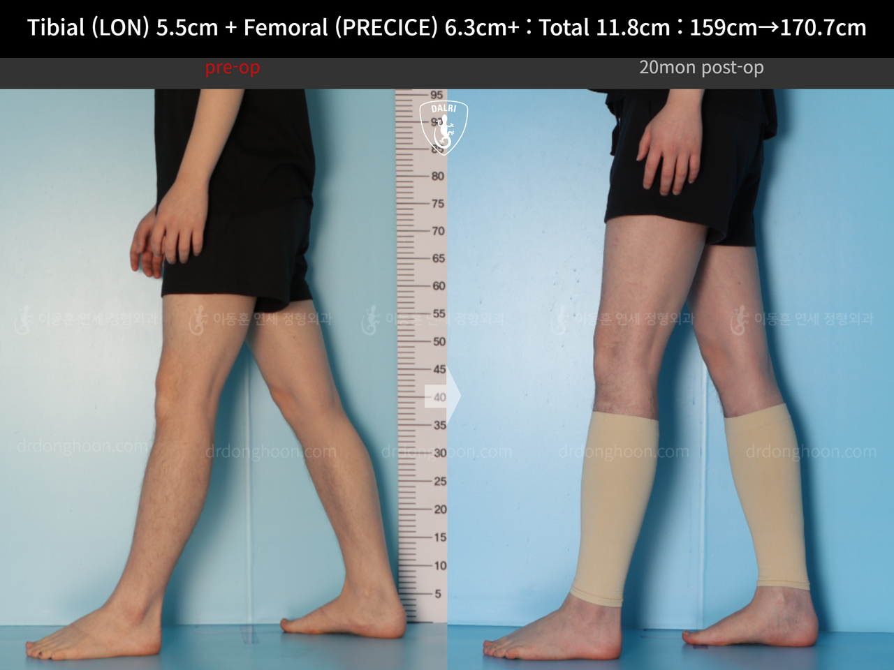 Before and after cll lon, case 14390077, image 9, Dr. Donghoon institute (DALRI)