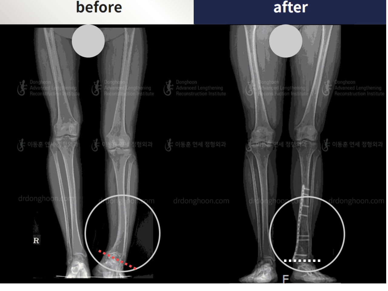 Before and after foot & ankle deformity, case 4248108, image 4, Dr. Donghoon institute (DALRI)