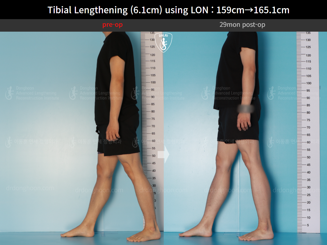Before and after cll lon, case 16723424, image 4, Dr. Donghoon institute (DALRI)
