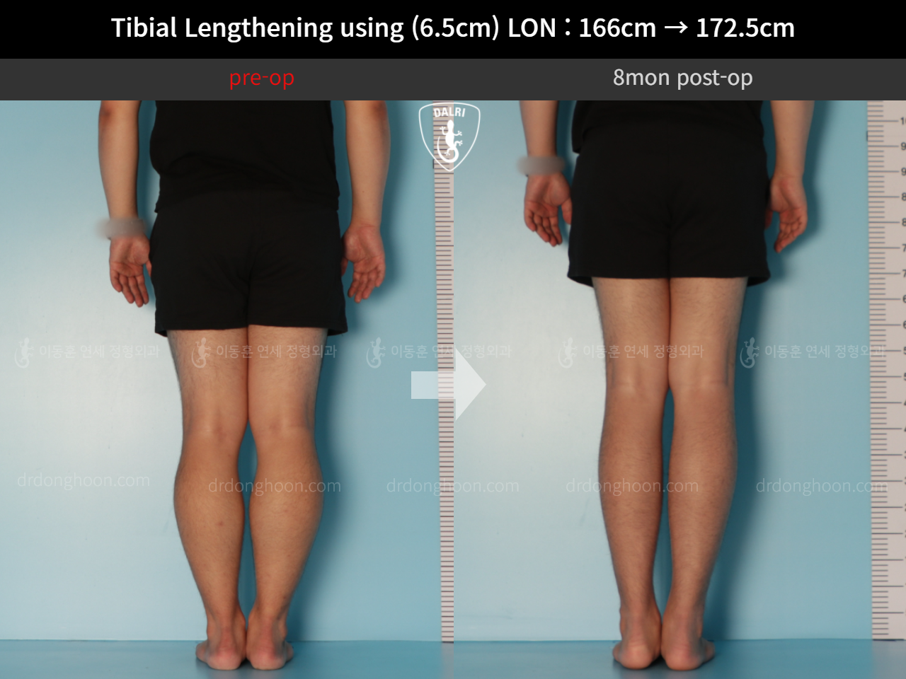 Before and after cll lon, case 11767706, image 5, Dr. Donghoon institute (DALRI)
