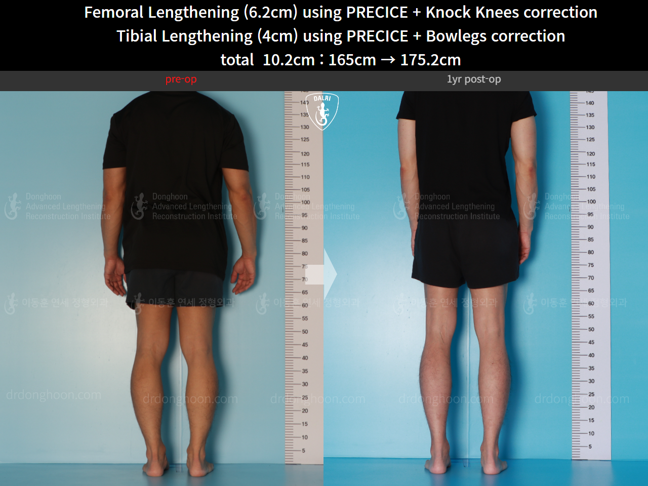 Before and after cll + deformity correction, case 15903252, image 5, Dr. Donghoon institute (DALRI)