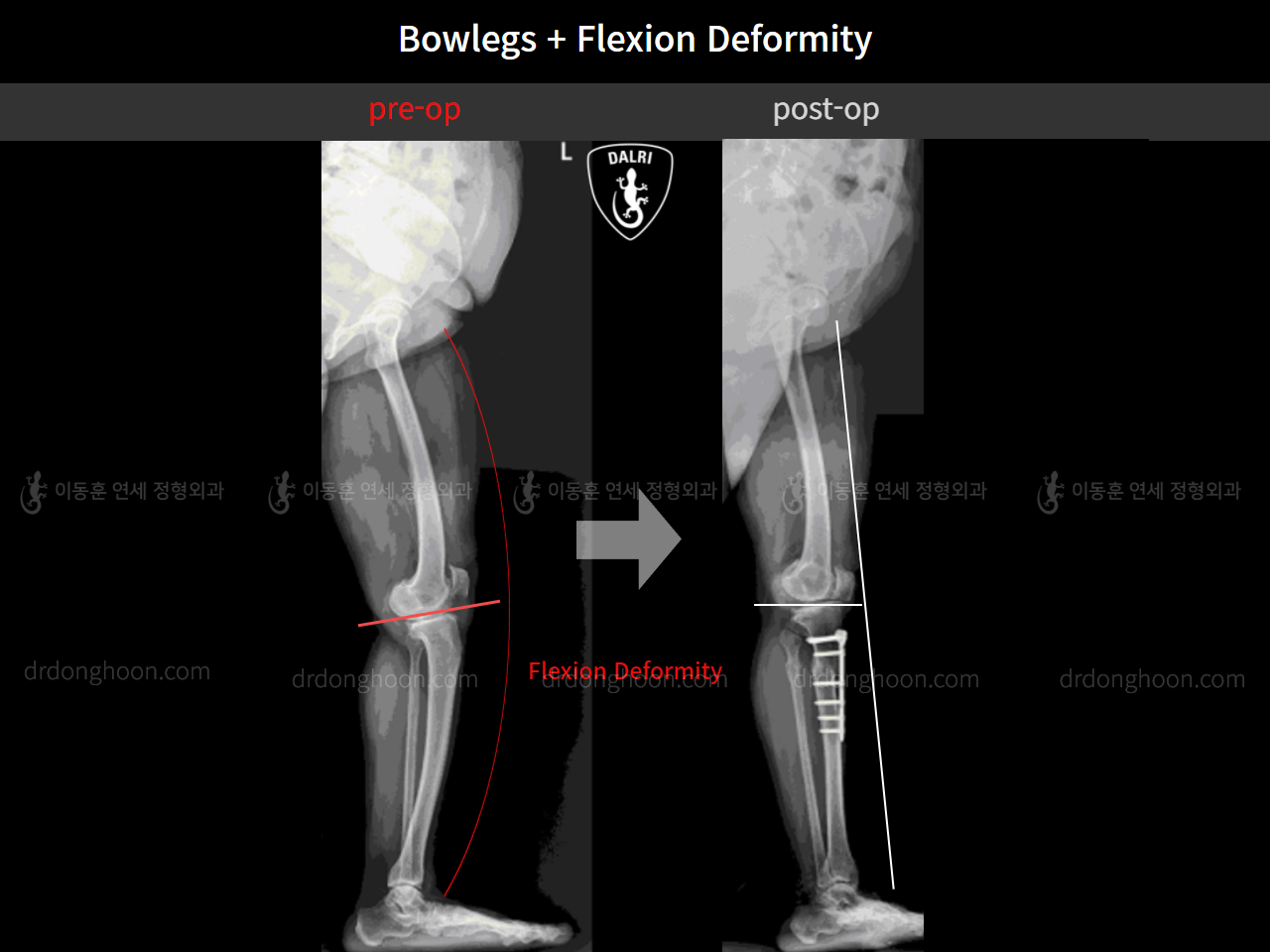 Before and after osteotomy for knee osteoarthritis, case 4586352, image 11, Dr. Donghoon institute (DALRI)